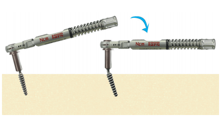 fog implantátum